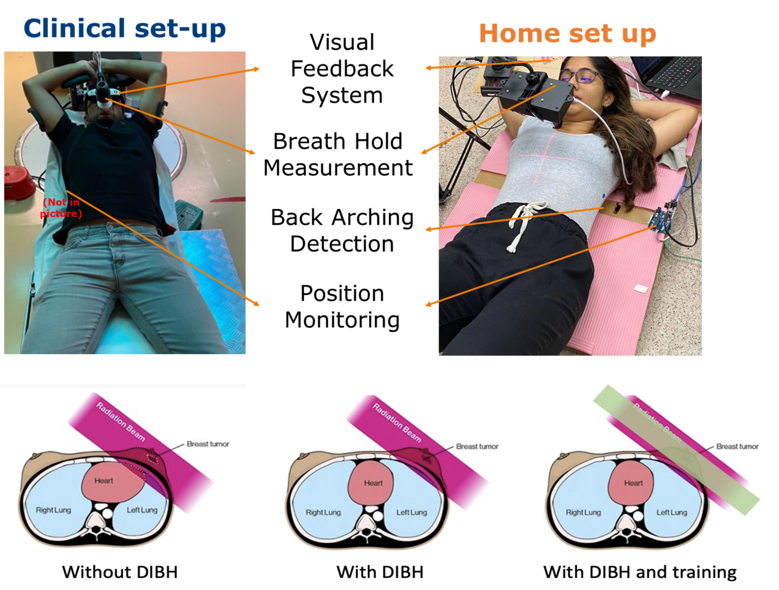 Deepinspiration breath hold trainer for breast cancer radiotherapy